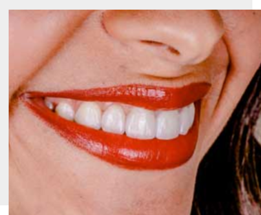 redukcja uśmiechu dziąsłowego